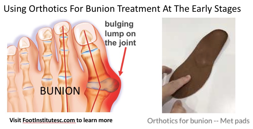 Bunion Treatment using Orthotics