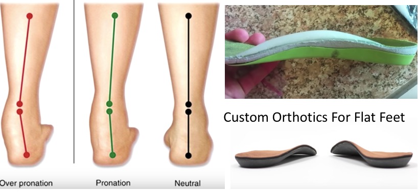 Flat Feet treatment using custom made orthotics